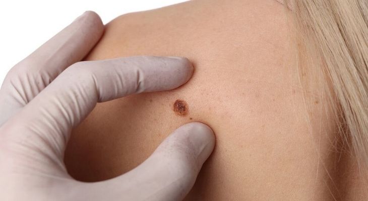 Skin Tag removal